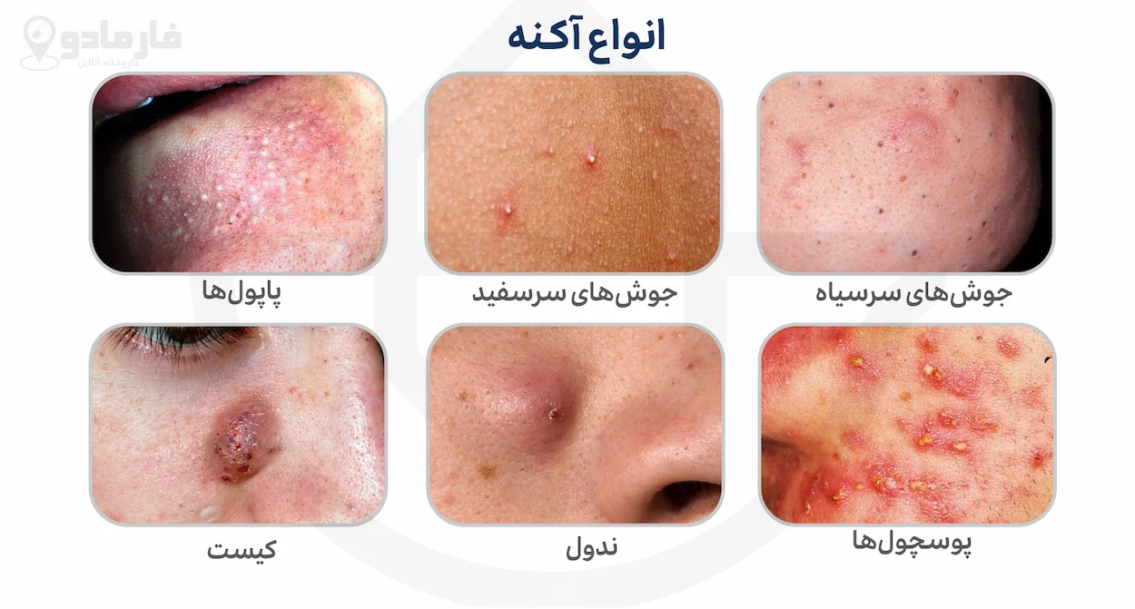 انواع آکنه با عکس