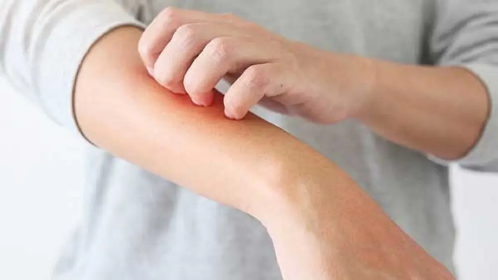 علائم پوستی مقاومت به انسولین