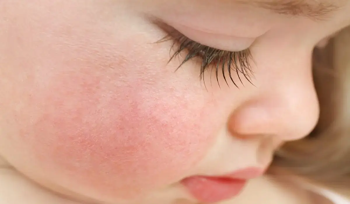 دلیل قرمزی پوست نوزاد