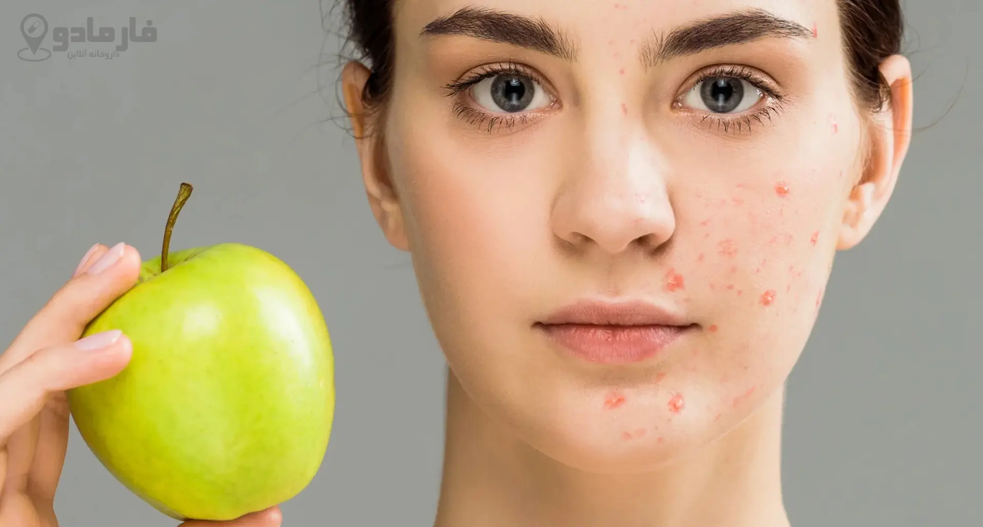 تاثیر رژیم غذایی بر جوش و آکنه