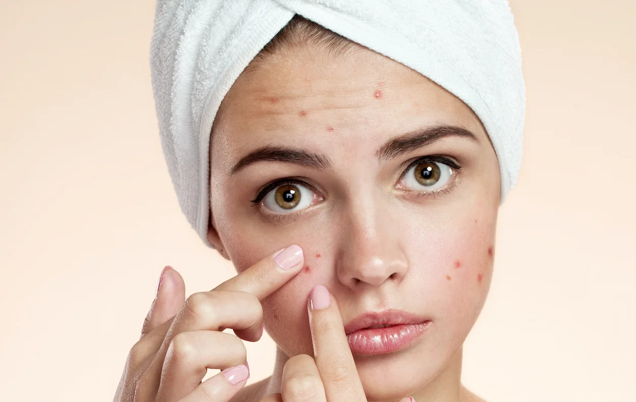 درمان سریع آکنه