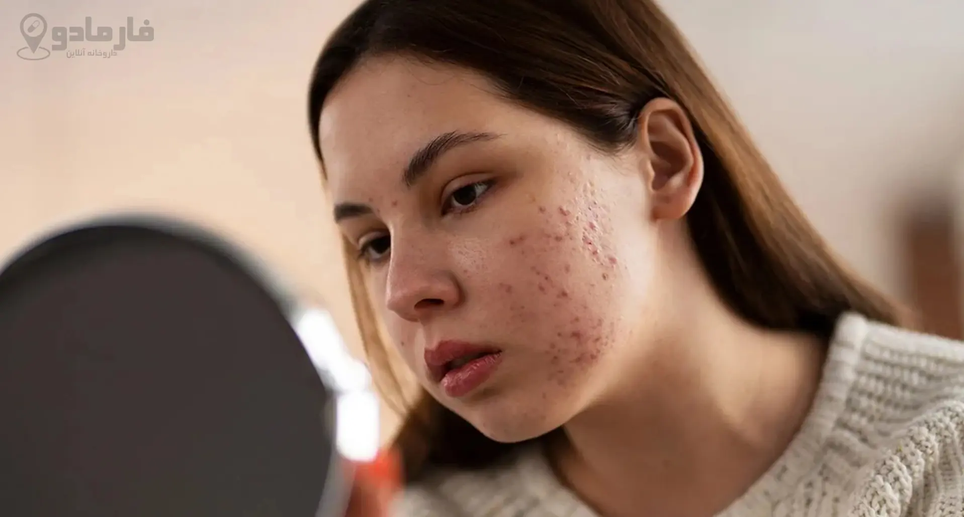 درمان جوش صورت در خانه