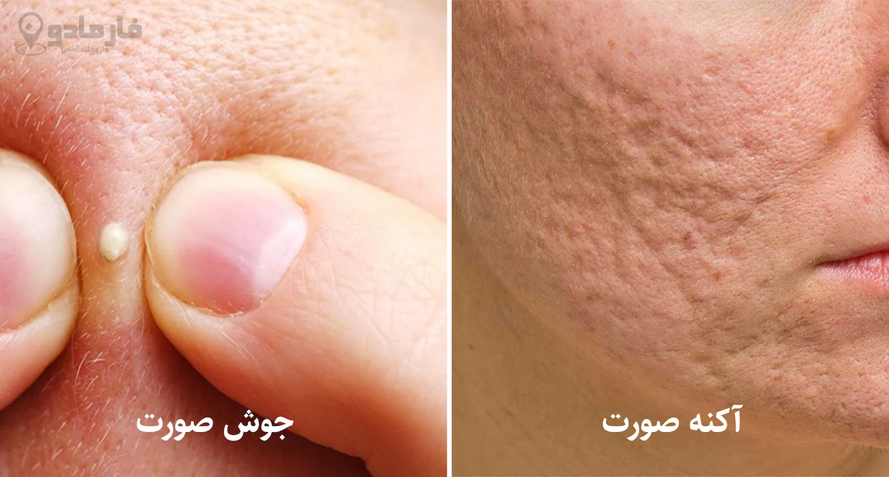 تفاوت آکنه و جوش