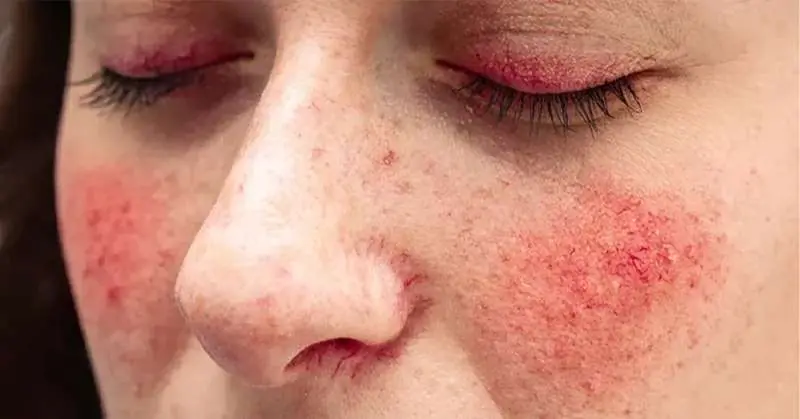 معایب استفاده از قرص پیگمنتا