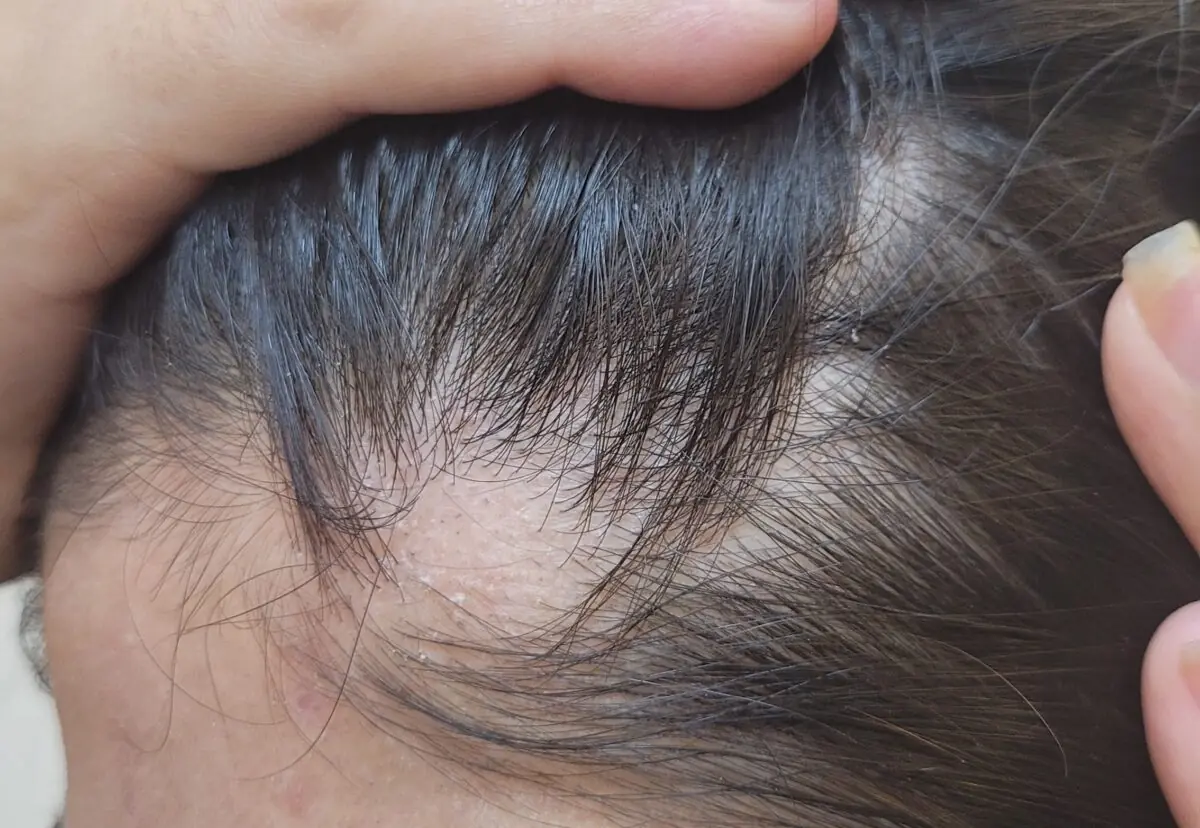 مضرات کافئین برای مو