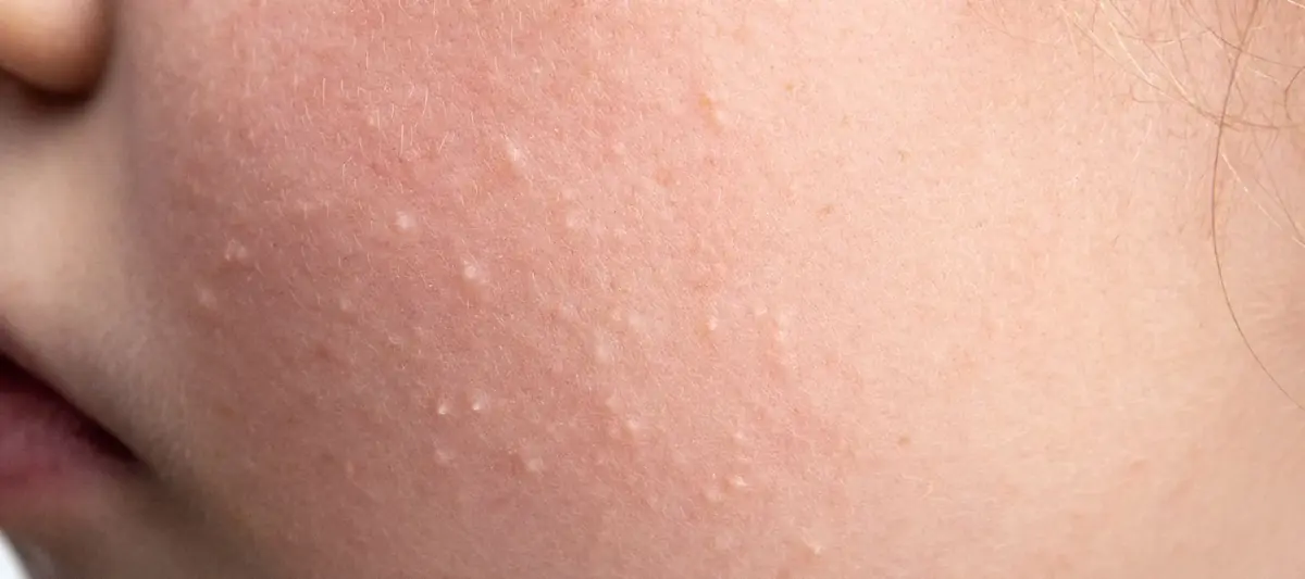 انواع لکهای پوستی بدن