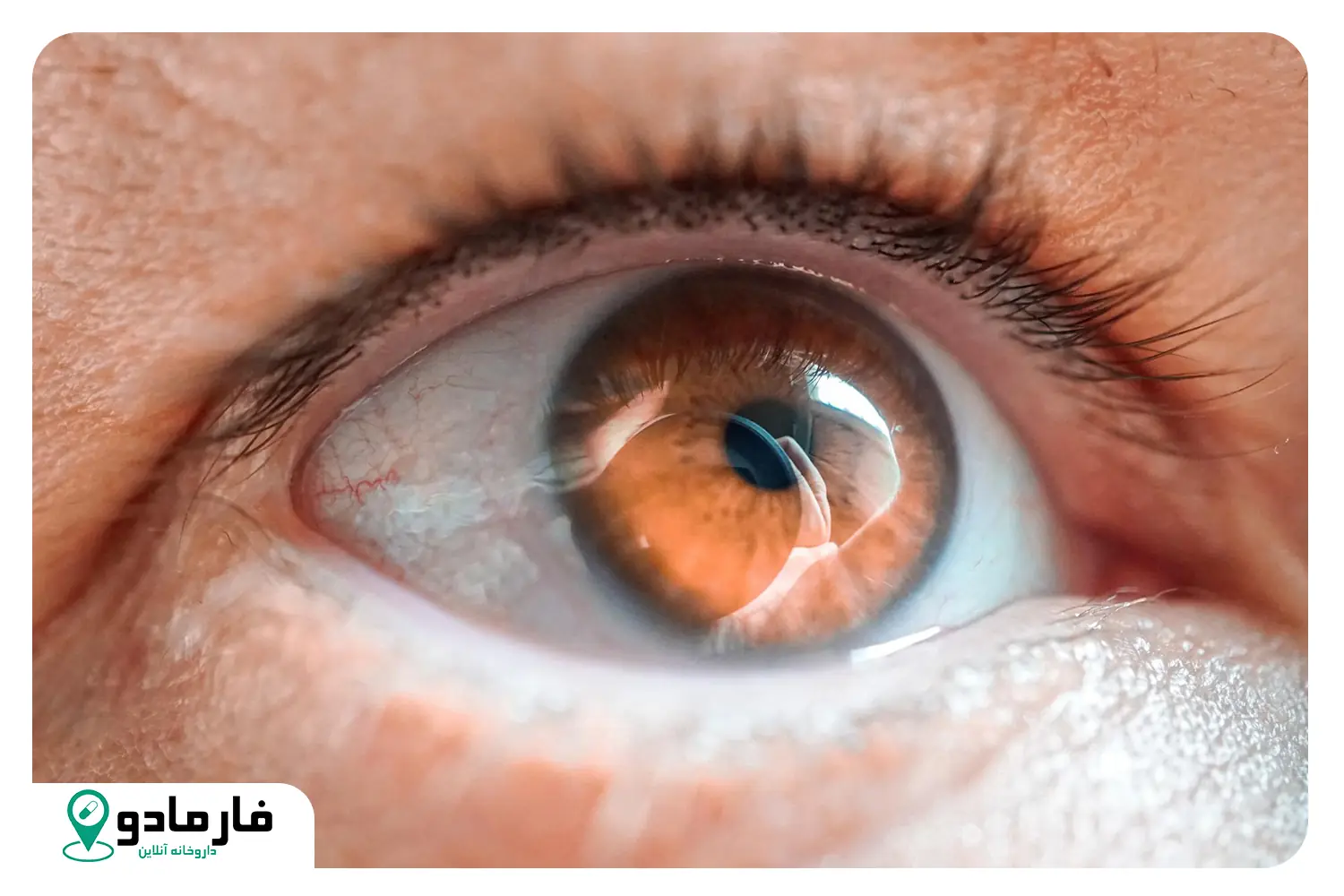 علائم آب مروارید که نباید نادیده بگیرید؛ ساده ولی مهم