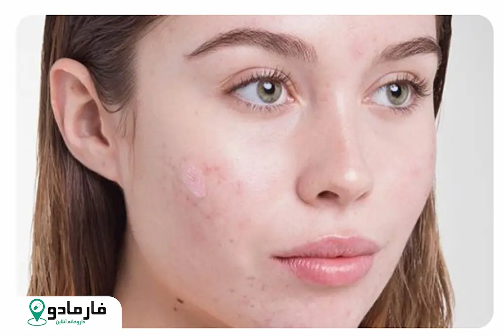 آیا هیالورونیک اسید باعث جوش می شود ؟