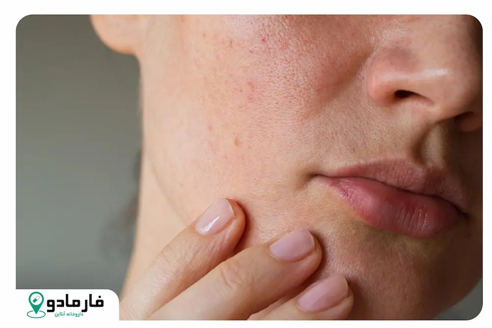 چگونه منافد باز پوست را ببندیم؟