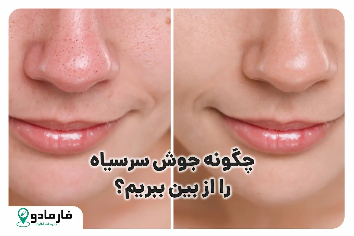 چجوری جوش سرسیاه را از بین ببریم؟