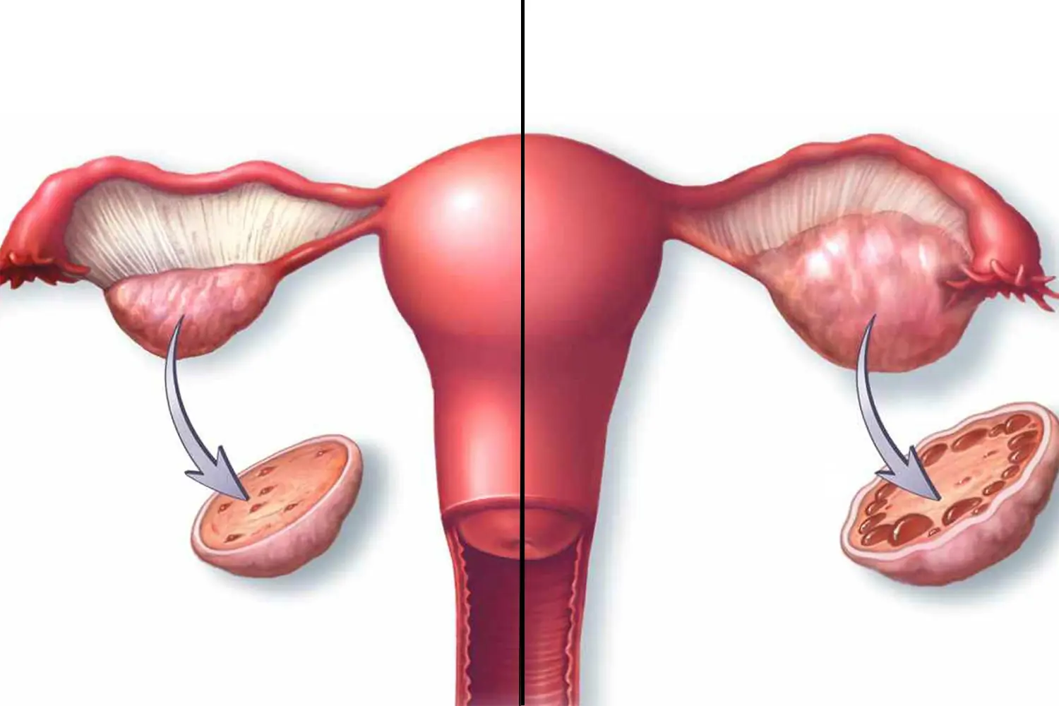 همه چیز درباره سندرم تخمدان پلی کیستیک (PCOS) و درمان آن